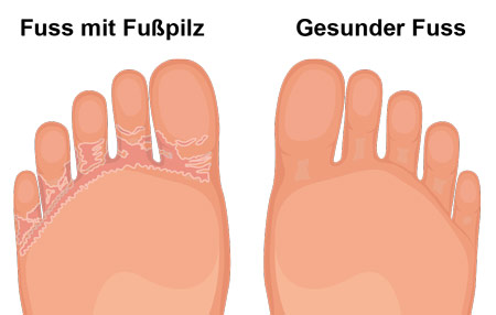 Fußpilz Fußsohle